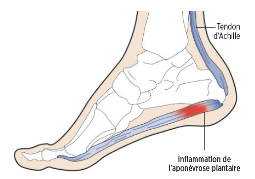 Aponévrose Plantaire