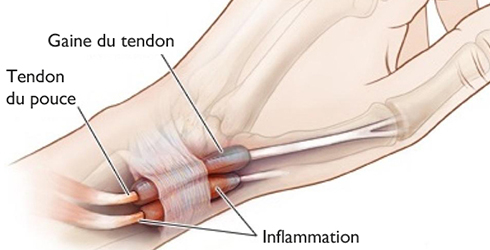image tendon poignet