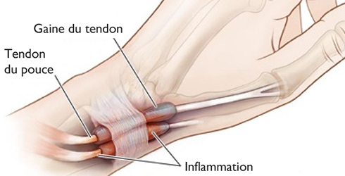 La Tendinite du Poignet [Zoom Sur Le Poignet]