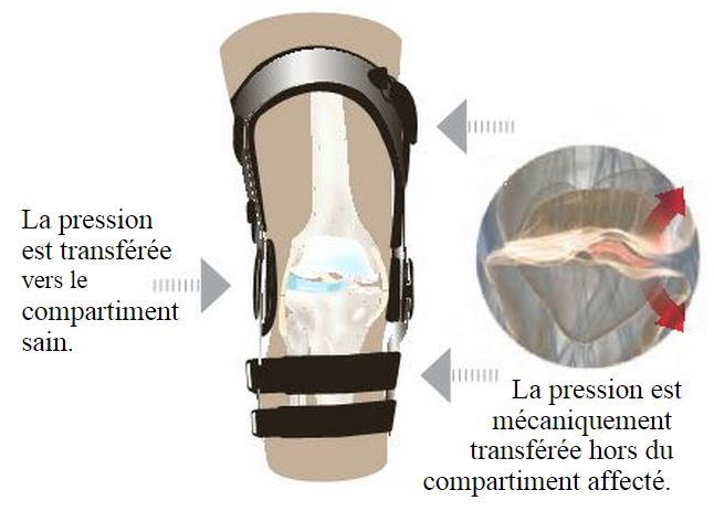 Attelle de gonarthrose OA FullForce Donjoy - Medical Domicile