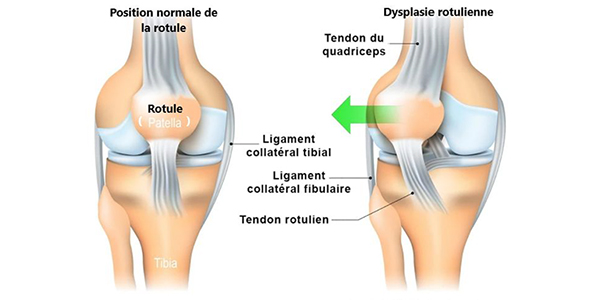 Genouillère  Sangles En Y - Instabilité Rotule - Luxation Rotulienne