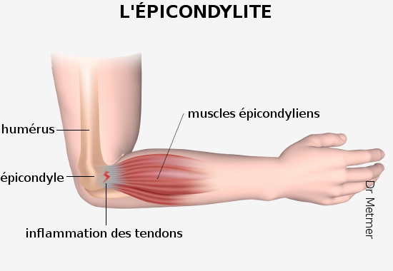 Épicondylite schéma 