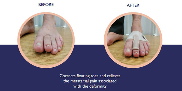 fixtoe pro MTP Predislocation Syndrome