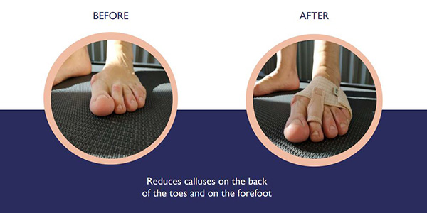 fixtoe pro flexible deformity