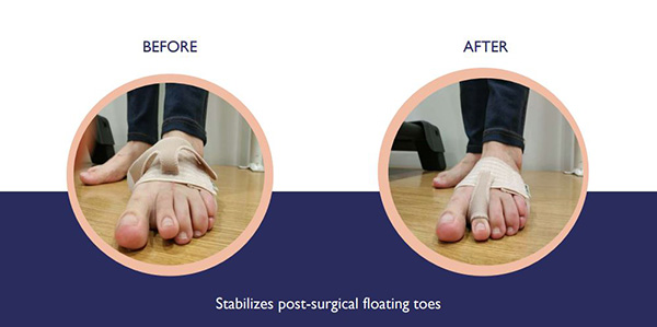 fixtoe pro post surgical stabilizer