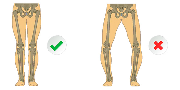 Genu Varum Symptomes Causes Et Traitements