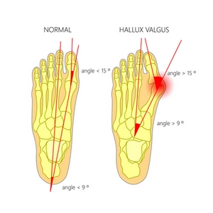 Illustration Hallux valgus