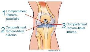 Gonarthrose (arthrose du genou) - Causes et traitements - Orliman