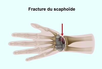 Fracture Du Scaphoïde [Zoom Sur]