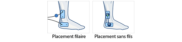 placements-electrodes-cheville-entorse