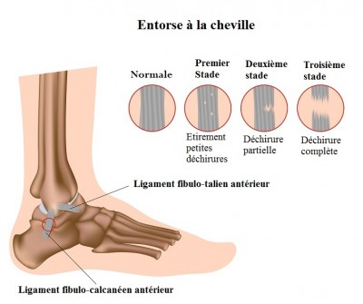 Entorse De La Cheville Zoom Sur