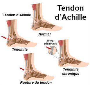 Tendinite Talon d'Achille Inflammation Douleurs Strapping Chevillère 