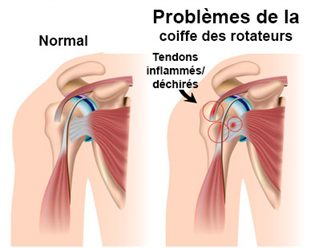 Formation kiné : tendinopathie épaule par électrothérapie 