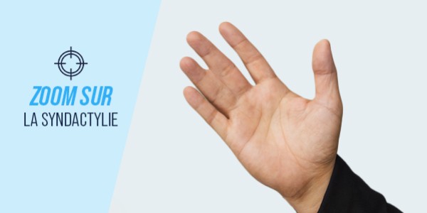 Article: Syndactylie : comprendre, traiter et accompagner la rééducation